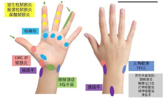 Read more about the article 手腕扭傷